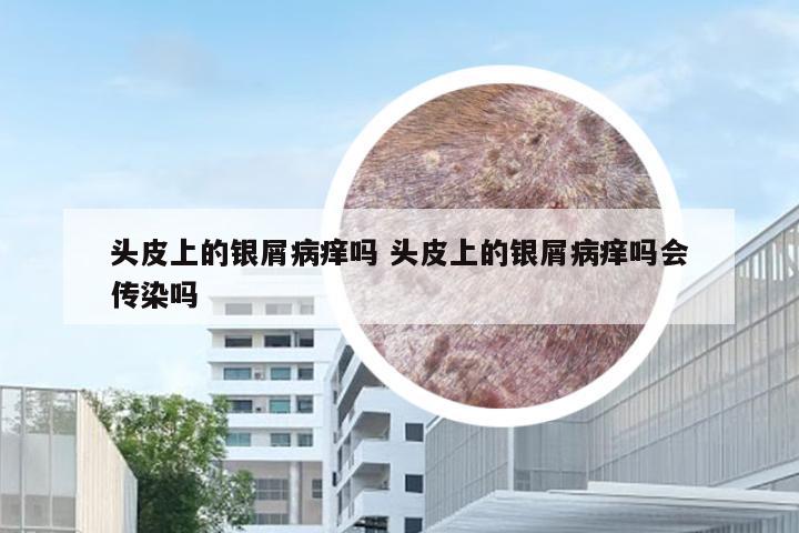 头皮上的银屑病痒吗 头皮上的银屑病痒吗会传染吗