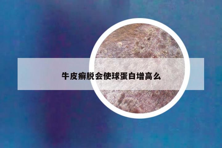 牛皮癣脱会使球蛋白增高么