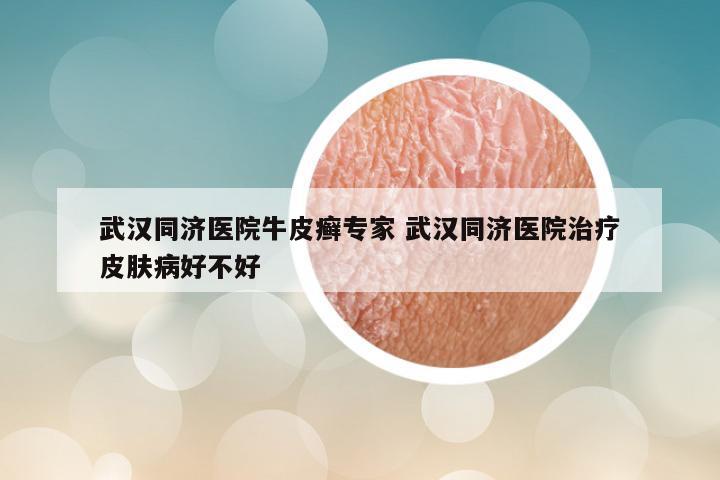 武汉同济医院牛皮癣专家 武汉同济医院治疗皮肤病好不好