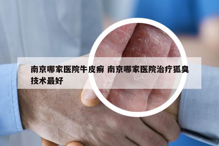 南京哪家医院牛皮癣 南京哪家医院治疗狐臭技术最好