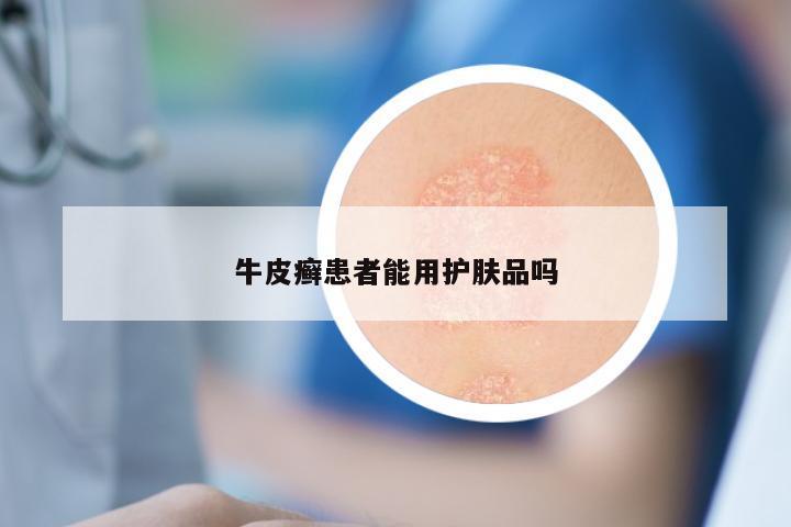 牛皮癣患者能用护肤品吗