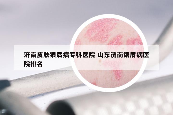 济南皮肤银屑病专科医院 山东济南银屑病医院排名