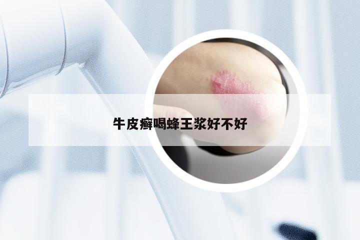 牛皮癣喝蜂王浆好不好