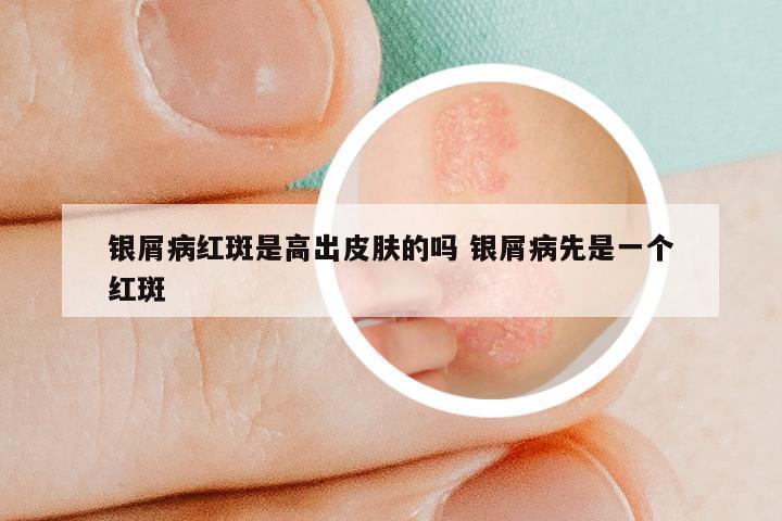 银屑病红斑是高出皮肤的吗 银屑病先是一个红斑
