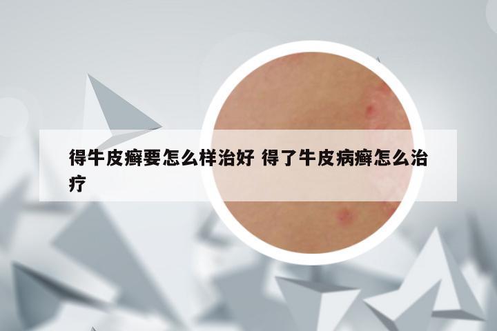 得牛皮癣要怎么样治好 得了牛皮病癣怎么治疗