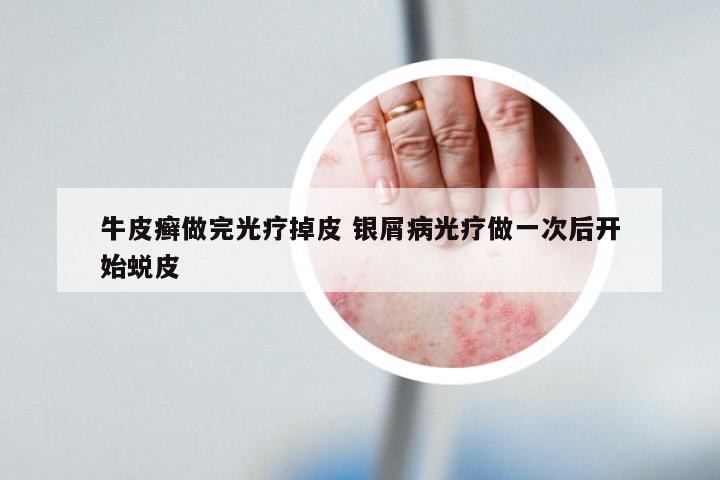 牛皮癣做完光疗掉皮 银屑病光疗做一次后开始蜕皮