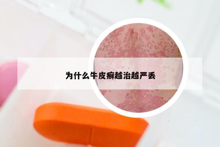 为什么牛皮癣越治越严丢