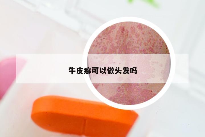 牛皮癣可以做头发吗