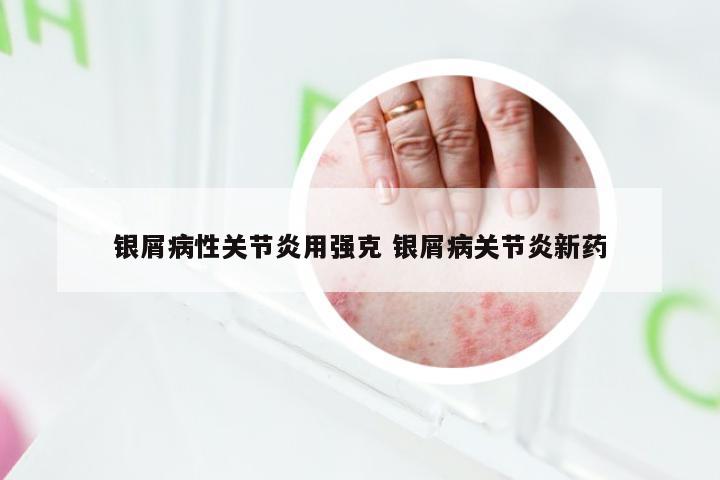 银屑病性关节炎用强克 银屑病关节炎新药