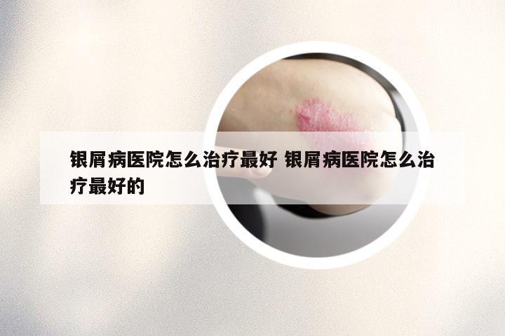 银屑病医院怎么治疗最好 银屑病医院怎么治疗最好的