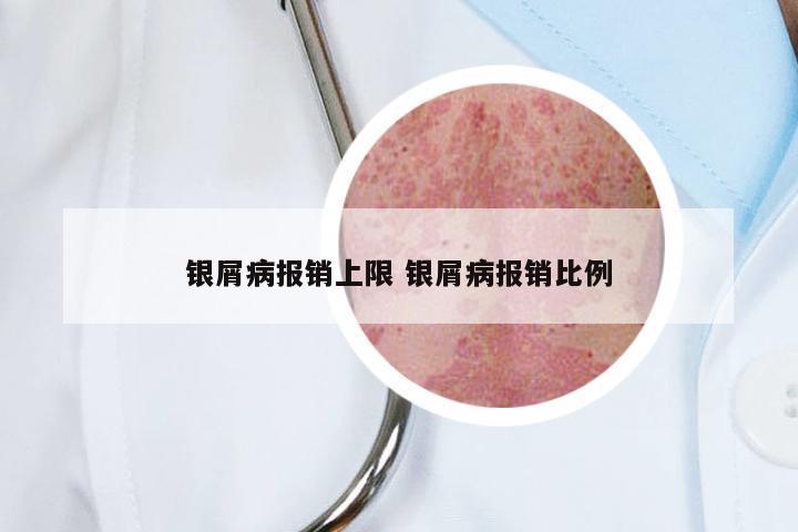 银屑病报销上限 银屑病报销比例