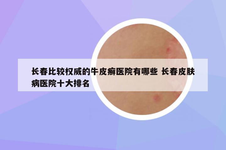 长春比较权威的牛皮癣医院有哪些 长春皮肤病医院十大排名