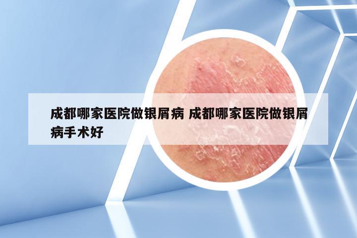 成都哪家医院做银屑病 成都哪家医院做银屑病手术好