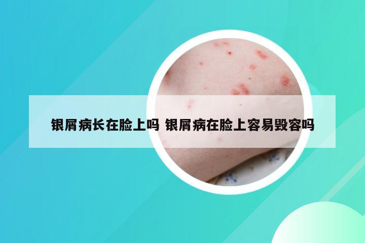银屑病长在脸上吗 银屑病在脸上容易毁容吗