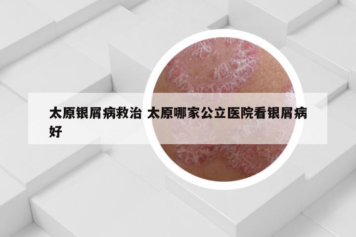 太原银屑病救治 太原哪家公立医院看银屑病好