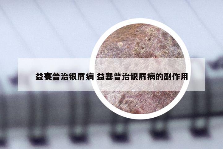 益赛普治银屑病 益塞普治银屑病的副作用