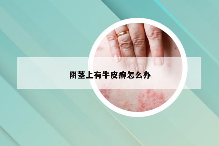 阴茎上有牛皮癣怎么办