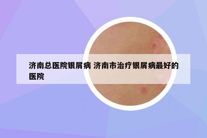 济南总医院银屑病 济南市治疗银屑病最好的医院