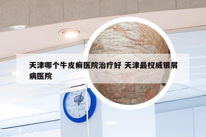 天津哪个牛皮癣医院治疗好 天津最权威银屑病医院