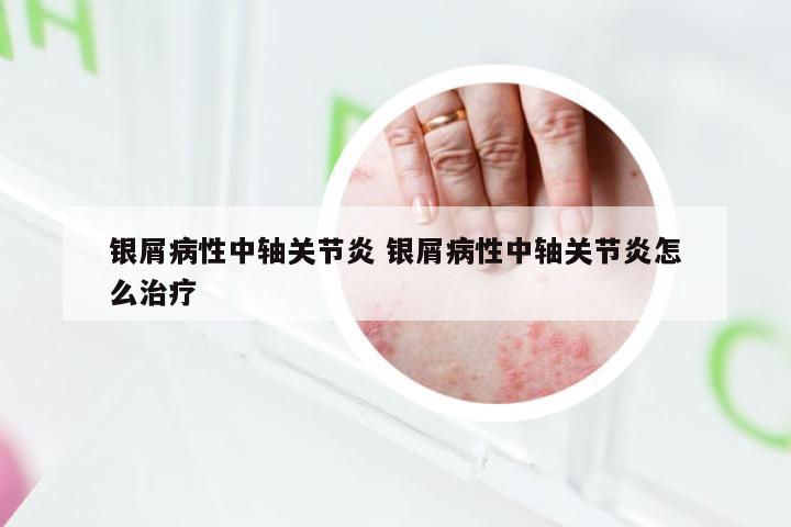 银屑病性中轴关节炎 银屑病性中轴关节炎怎么治疗