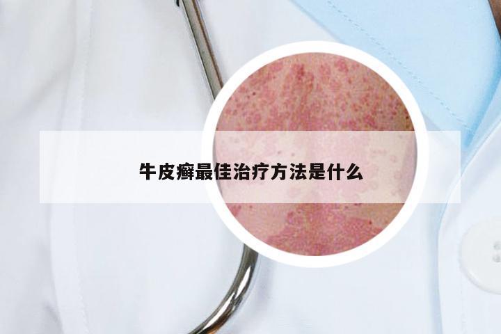 牛皮癣最佳治疗方法是什么