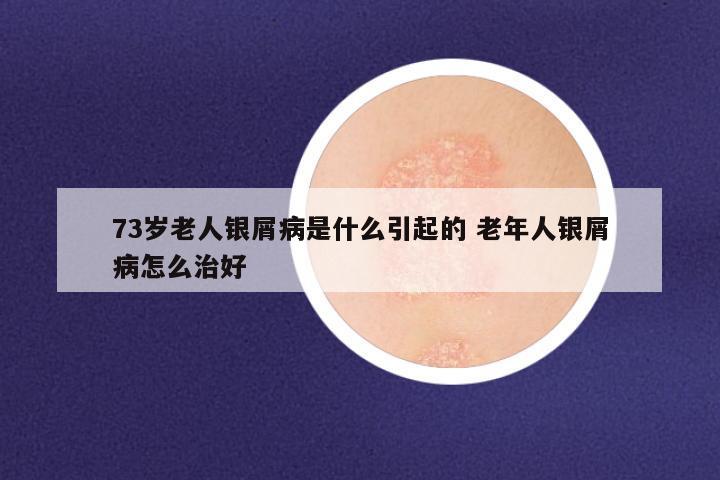 73岁老人银屑病是什么引起的 老年人银屑病怎么治好