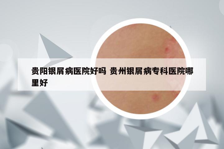贵阳银屑病医院好吗 贵州银屑病专科医院哪里好