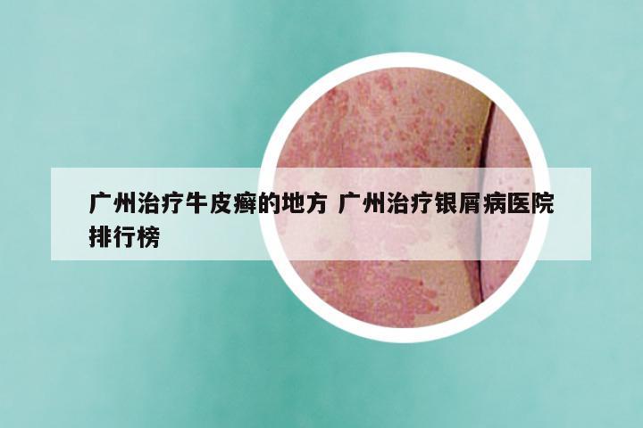 广州治疗牛皮癣的地方 广州治疗银屑病医院排行榜