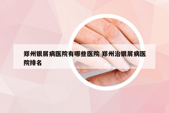 郑州银屑病医院有哪些医院 郑州治银屑病医院排名