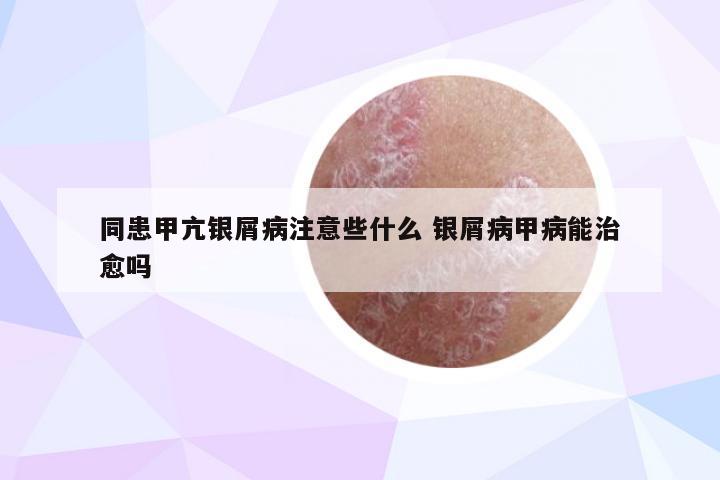 同患甲亢银屑病注意些什么 银屑病甲病能治愈吗