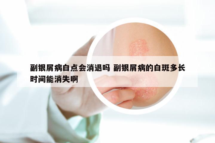 副银屑病白点会消退吗 副银屑病的白斑多长时间能消失啊