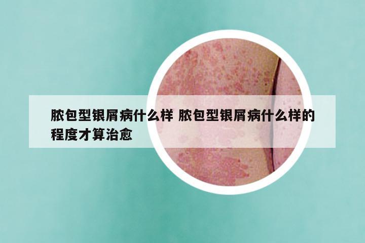 脓包型银屑病什么样 脓包型银屑病什么样的程度才算治愈