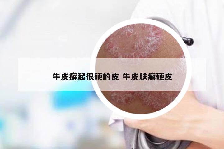 牛皮癣起很硬的皮 牛皮肤癣硬皮