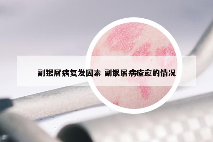 副银屑病复发因素 副银屑病痊愈的情况