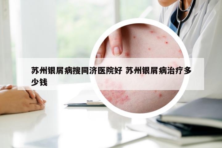 苏州银屑病搜同济医院好 苏州银屑病治疗多少钱