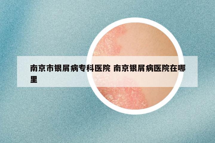 南京市银屑病专科医院 南京银屑病医院在哪里