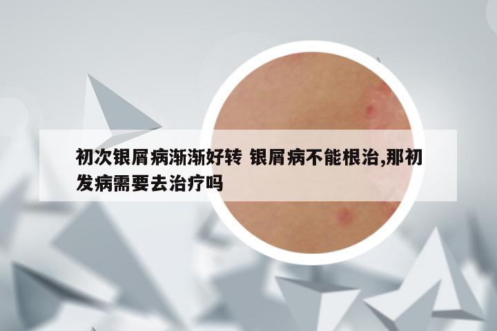 初次银屑病渐渐好转 银屑病不能根治,那初发病需要去治疗吗
