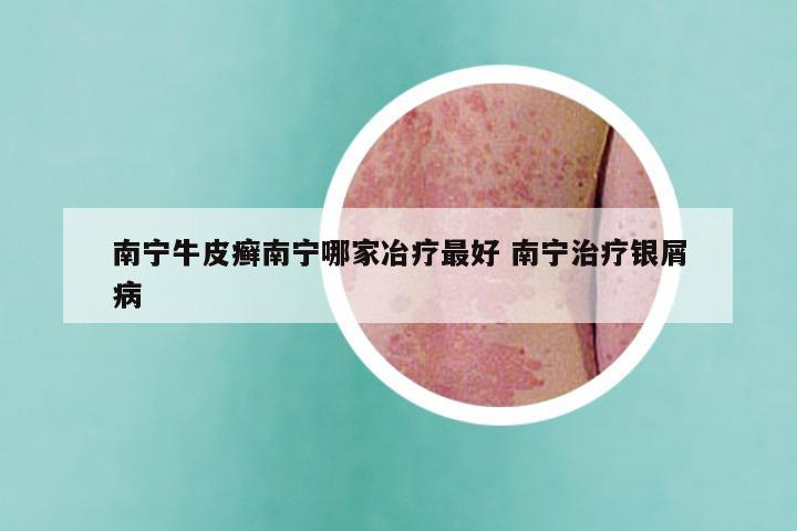 南宁牛皮癣南宁哪家冶疗最好 南宁治疗银屑病