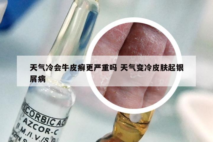 天气冷会牛皮癣更严重吗 天气变冷皮肤起银屑病