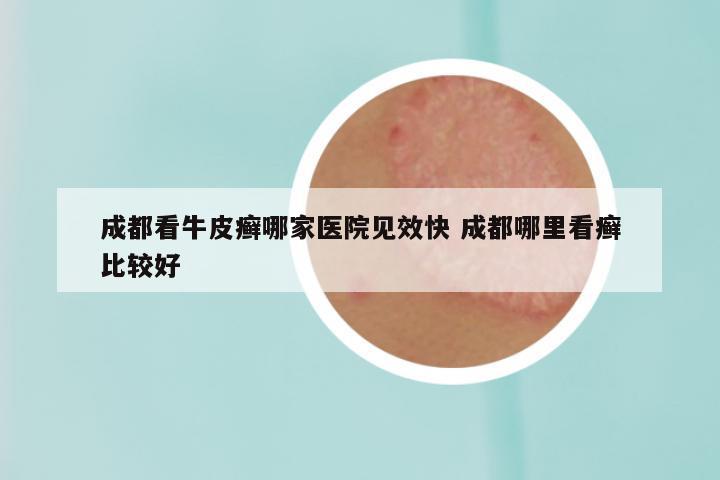 成都看牛皮癣哪家医院见效快 成都哪里看癣比较好