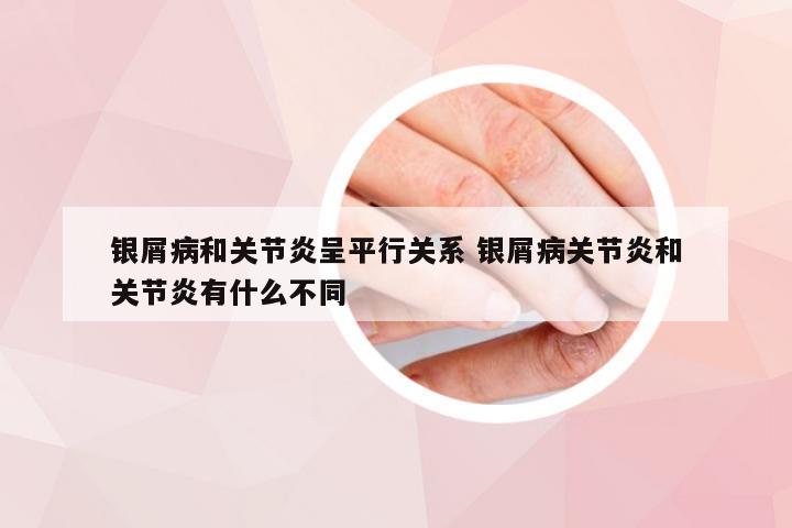 银屑病和关节炎呈平行关系 银屑病关节炎和关节炎有什么不同