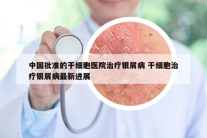 中国批准的干细胞医院治疗银屑病 干细胞治疗银屑病最新进展