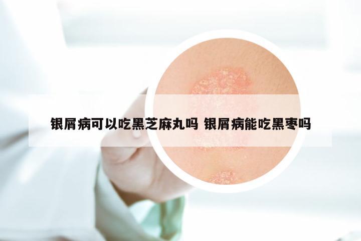 银屑病可以吃黑芝麻丸吗 银屑病能吃黑枣吗