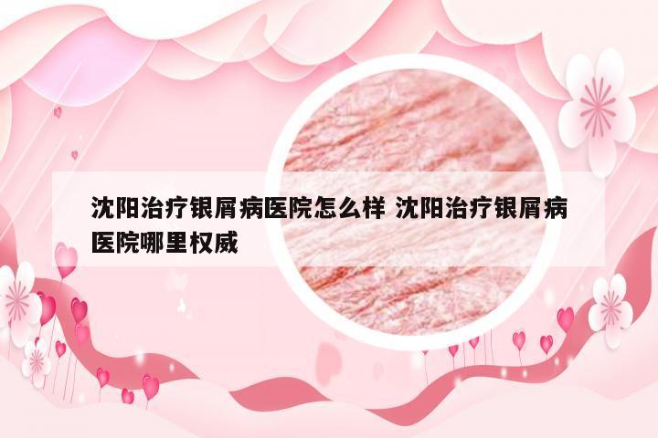 沈阳治疗银屑病医院怎么样 沈阳治疗银屑病医院哪里权威