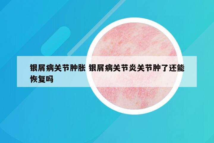 银屑病关节肿胀 银屑病关节炎关节肿了还能恢复吗