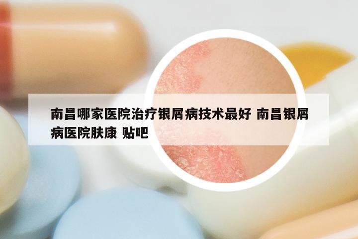 南昌哪家医院治疗银屑病技术最好 南昌银屑病医院肤康 贴吧