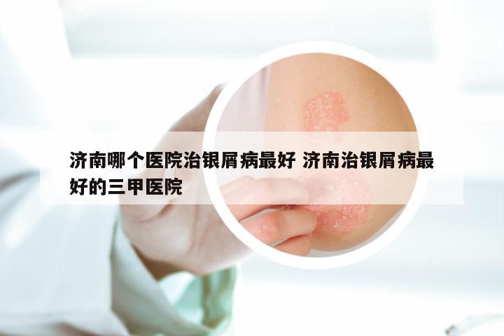 济南哪个医院治银屑病最好 济南治银屑病最好的三甲医院