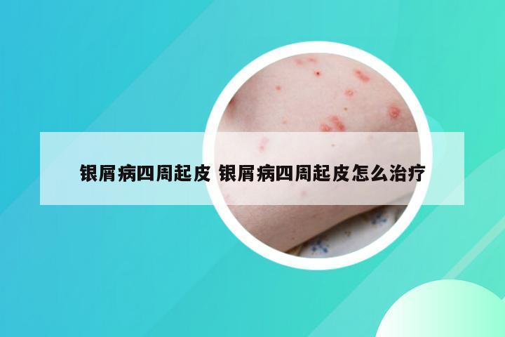 银屑病四周起皮 银屑病四周起皮怎么治疗