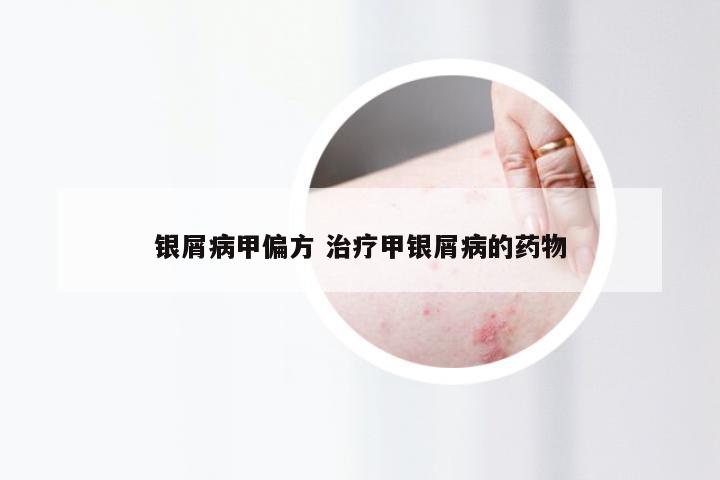 银屑病甲偏方 治疗甲银屑病的药物