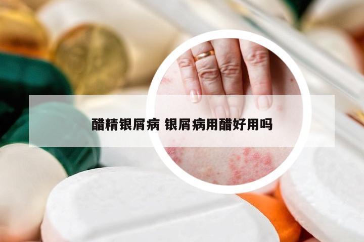 醋精银屑病 银屑病用醋好用吗